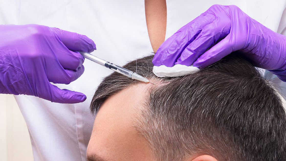 PRP-Therapy-1170×658